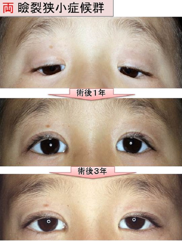 先天性眼瞼下垂｜筋膜移植｜挙筋前転｜瞼裂狭小症候群｜症例写真